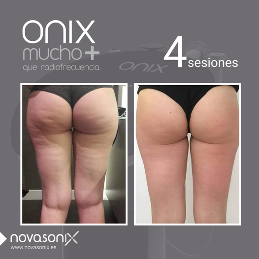 Centro de estética Avanzada Cuida-T glúteos antes y después de tratamiento